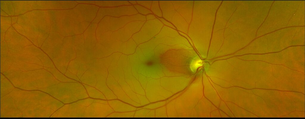 mid atlantic retina philadelphia