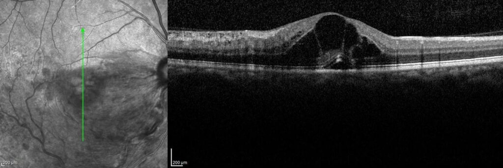 wills eye mid atlantic retina