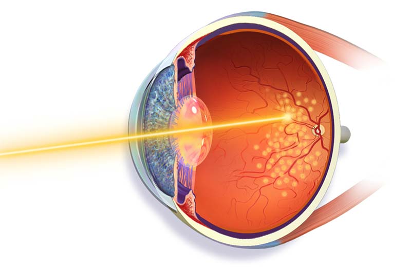 Retinal Laser Photocoagulation