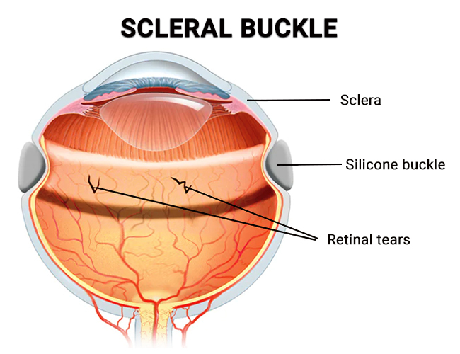 Scleral Buckle Surgery