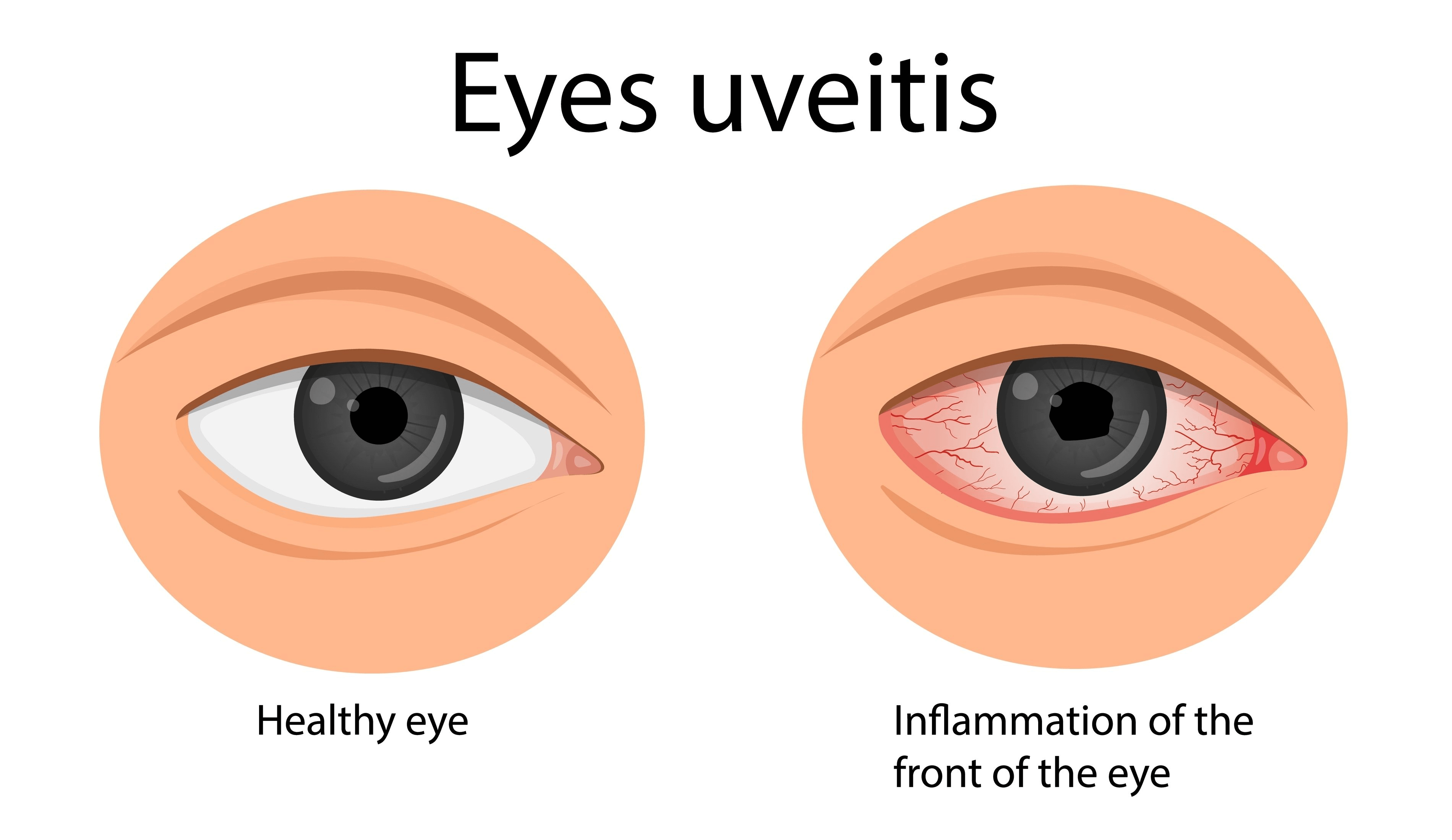What is Uveitis