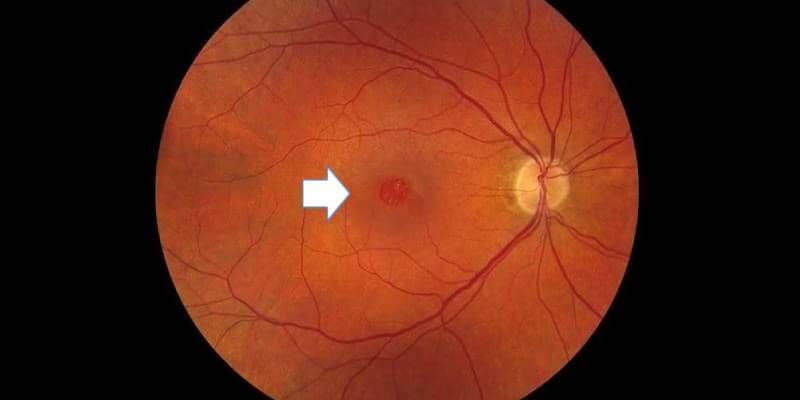 Macular Hole Stages