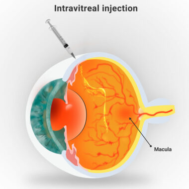 Eye Injections for Macular Degeneration