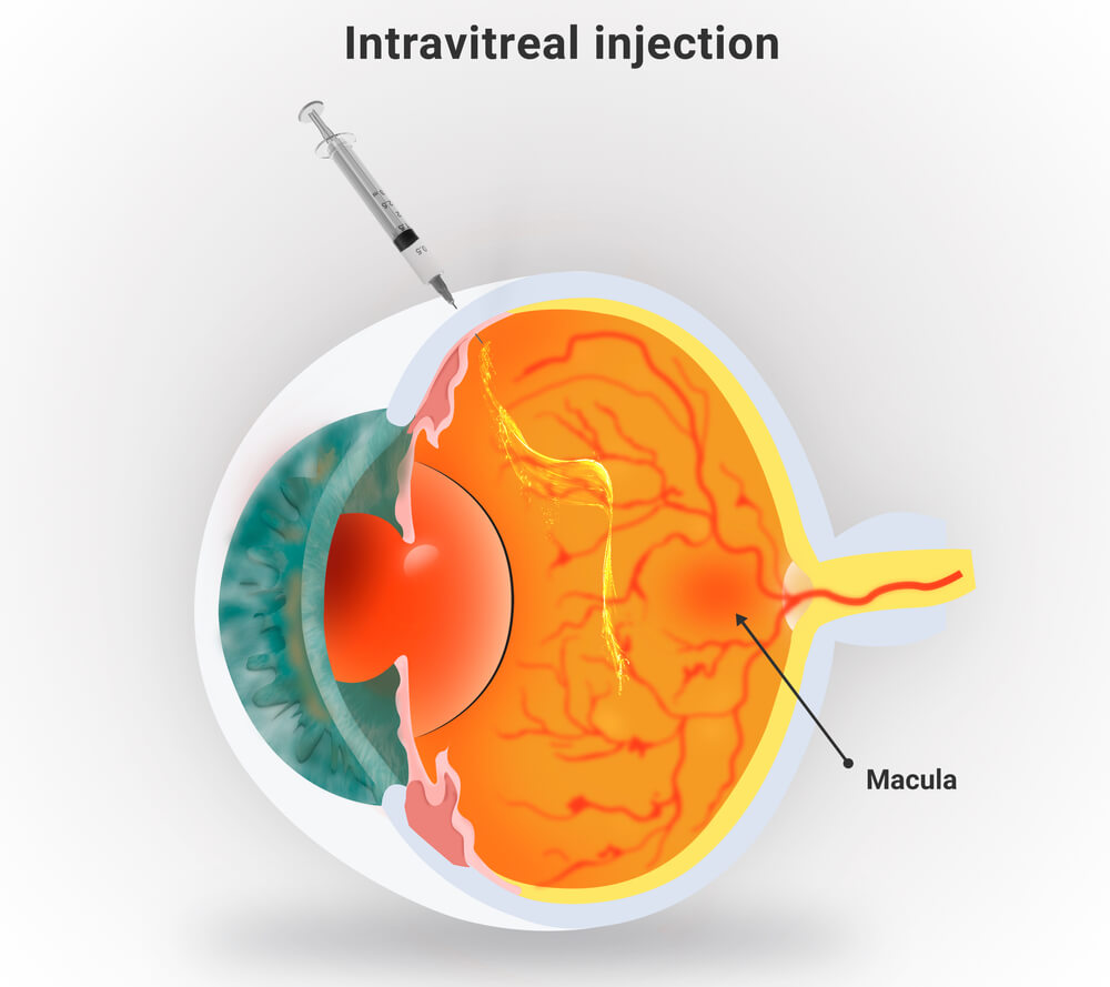 Intravitreal Injection, Eye Injections for Macular Degeneration