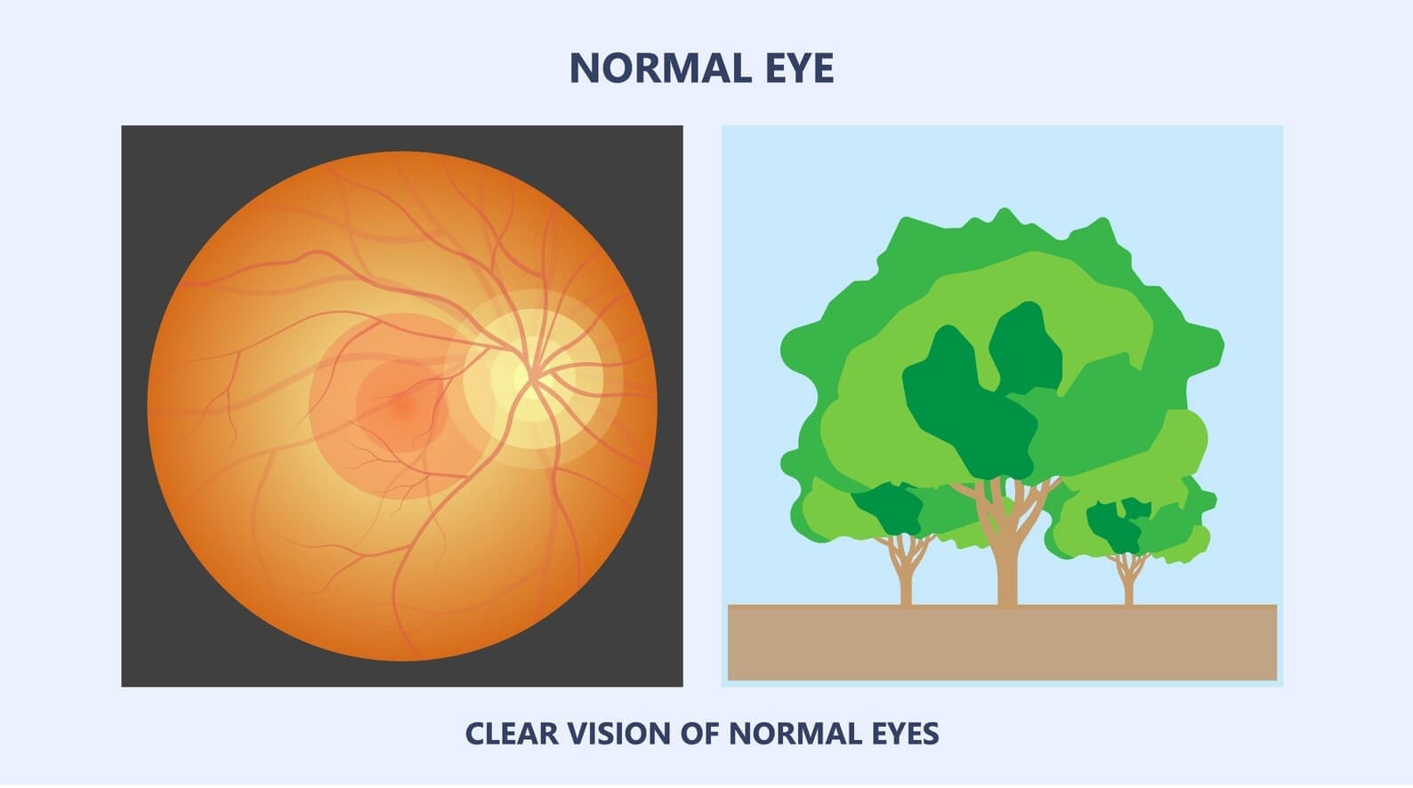 AMD normal vision