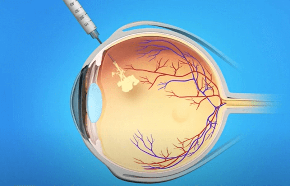 Eye Injections for Diabetic Retinopathy