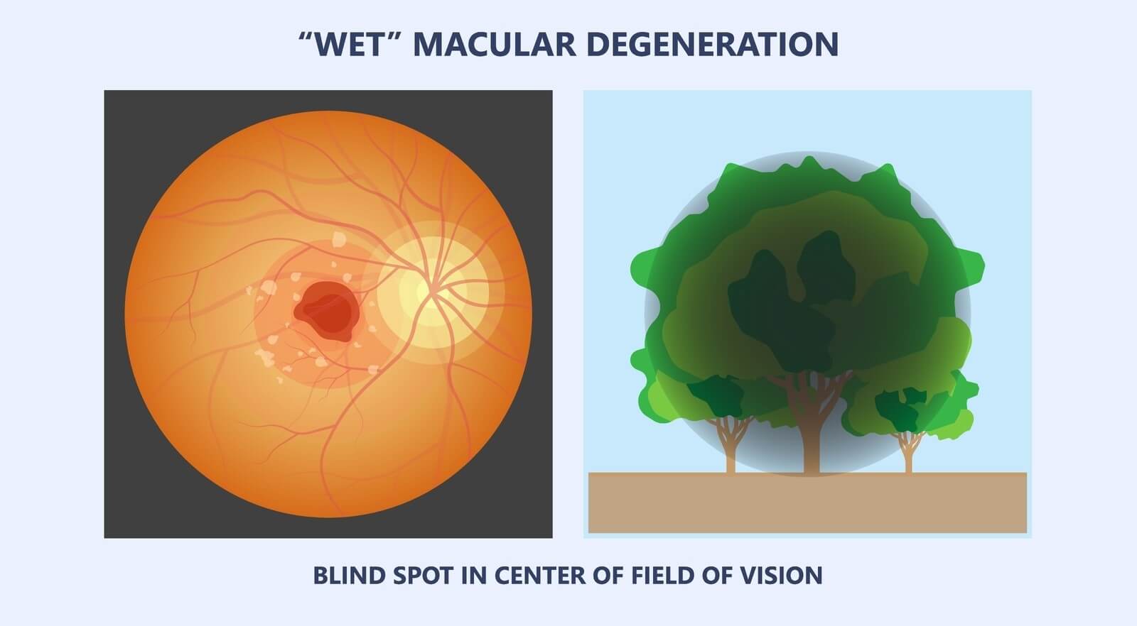 Wet AMD vision