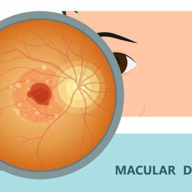 New Treatment for Macular Degeneration