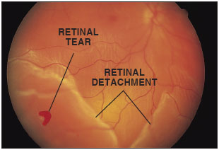 Tear in Retina
