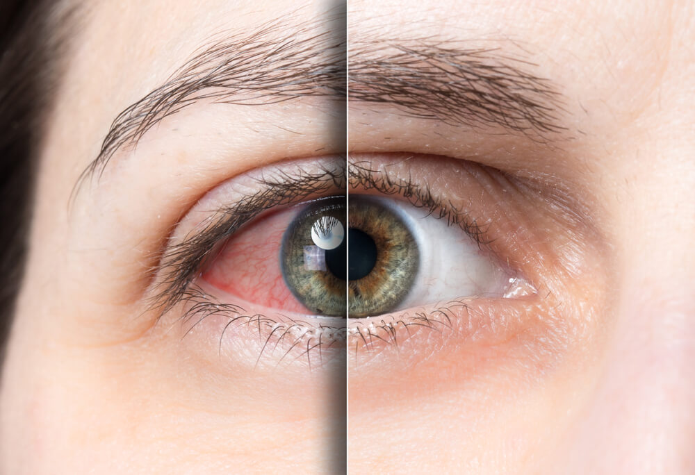 Can Diabetes Cause Dry Eyes