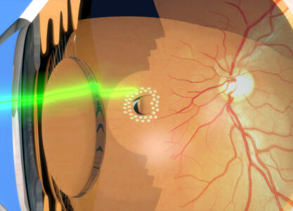 Retinal Laser Surgery