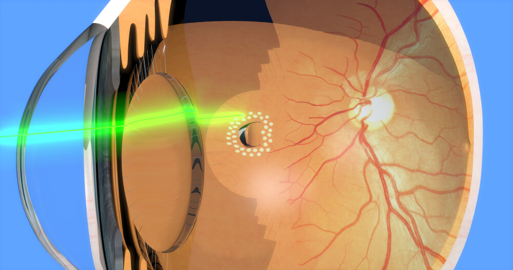 Retinal Laser Surgery