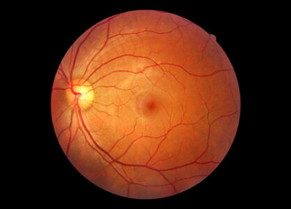 What is Retinal Imaging